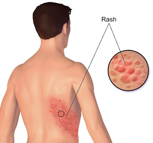 Salute - Fuoco di Sant'Antonio